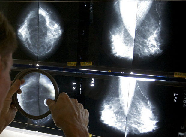 breast cancer screening_162890