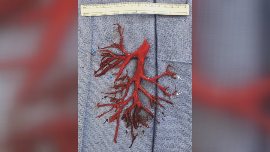 lung blood clot